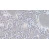 Human Pancreatic Cancer Cell Line, #CFPAC-1