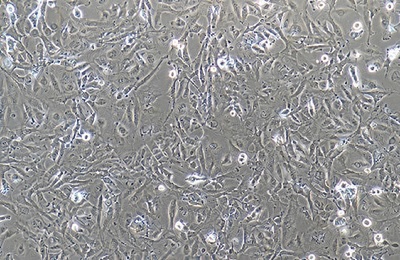 Migratory Cell Carcinoma Of The Human Urinary Bladder, #J82